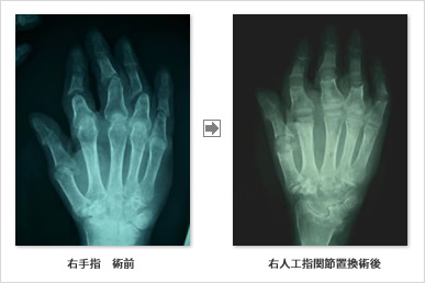 リウマチ性指関節症