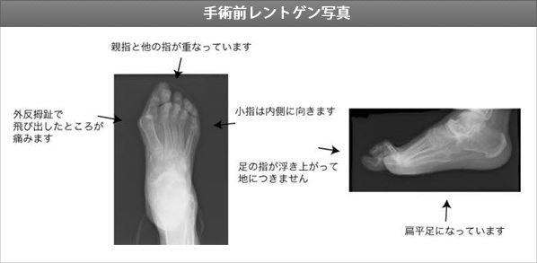 手術前レントゲン写真
