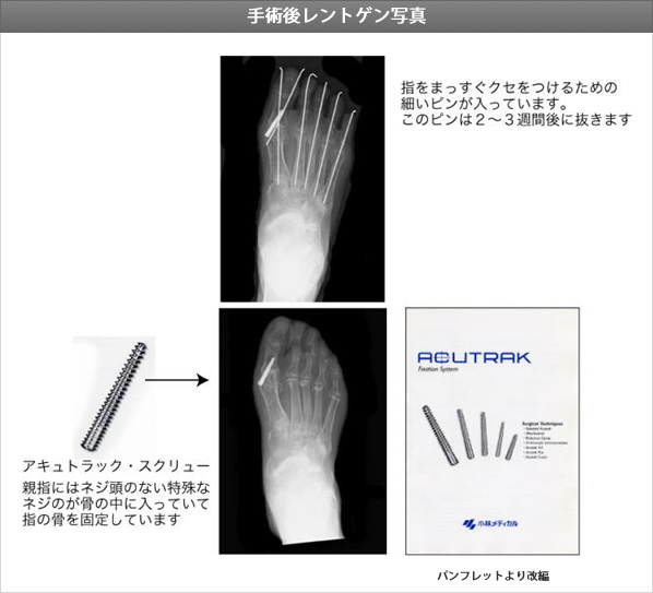 手術後レントゲン写真