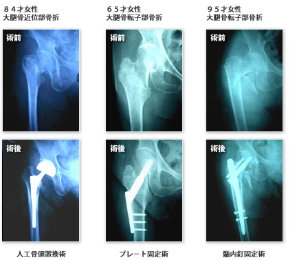大腿骨近位部骨折