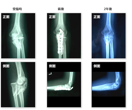 骨折