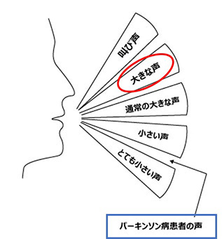 図12 パーキンソン病患者さんの声の大きさ(青枠)