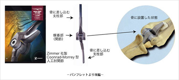 ジンマー社製の人工肘関節