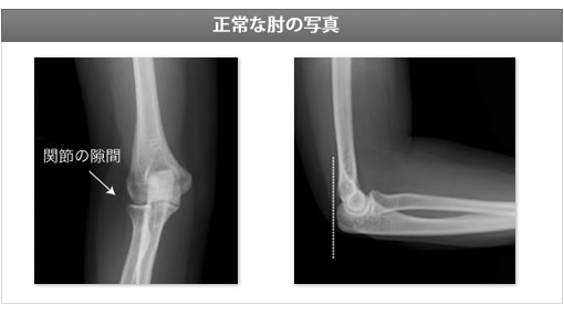 人工肘関節手術の例