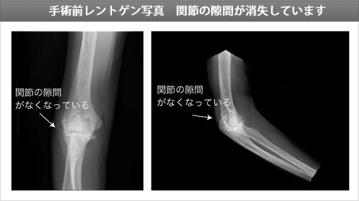 人工肘関節手術の例