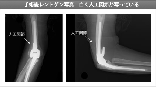 人工肘関節手術の例