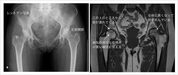 リウマチ性股関節症