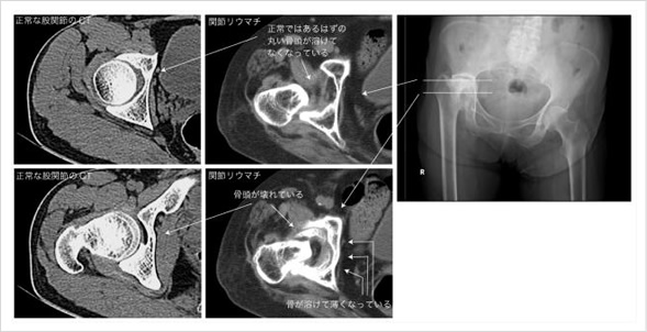 JMM社のKTプレートを使った高度破壊股関節の再建