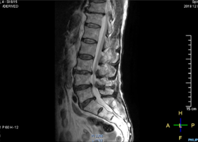 【腰椎MRI】