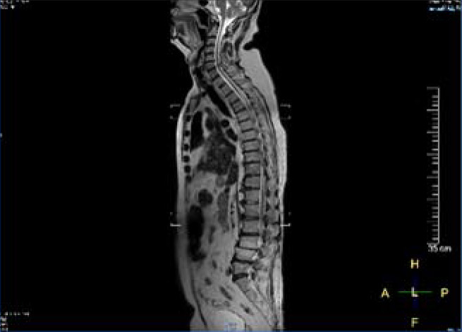 【全脊椎MRI】