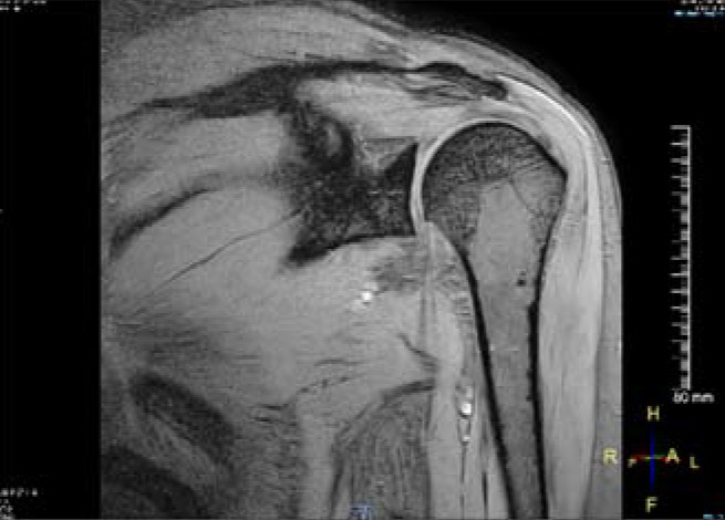 【肩関節MRI】