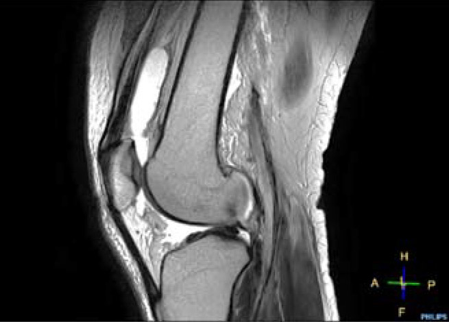 【膝関節MRI】